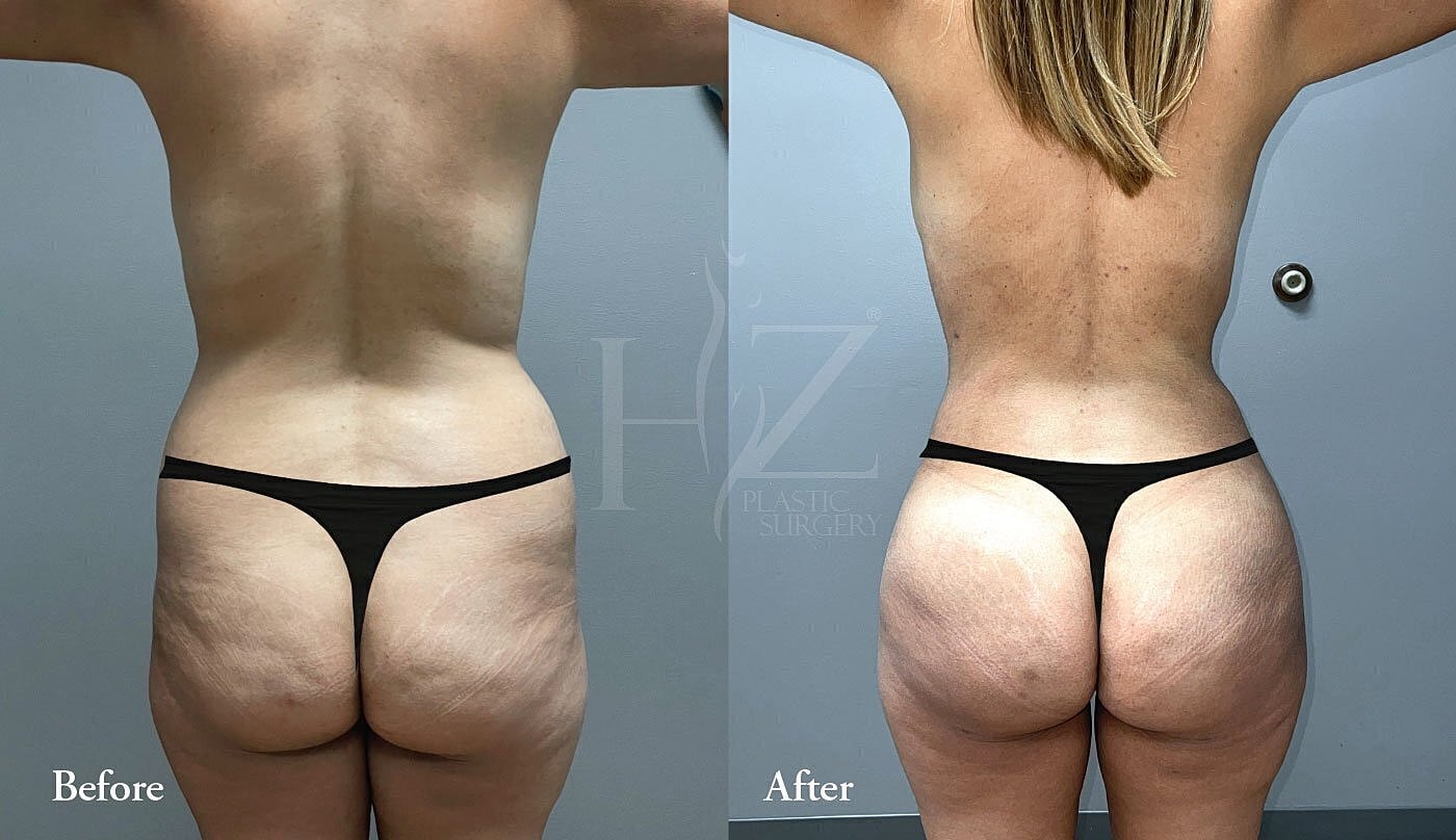 brazilian butt lift patient before and after 3
