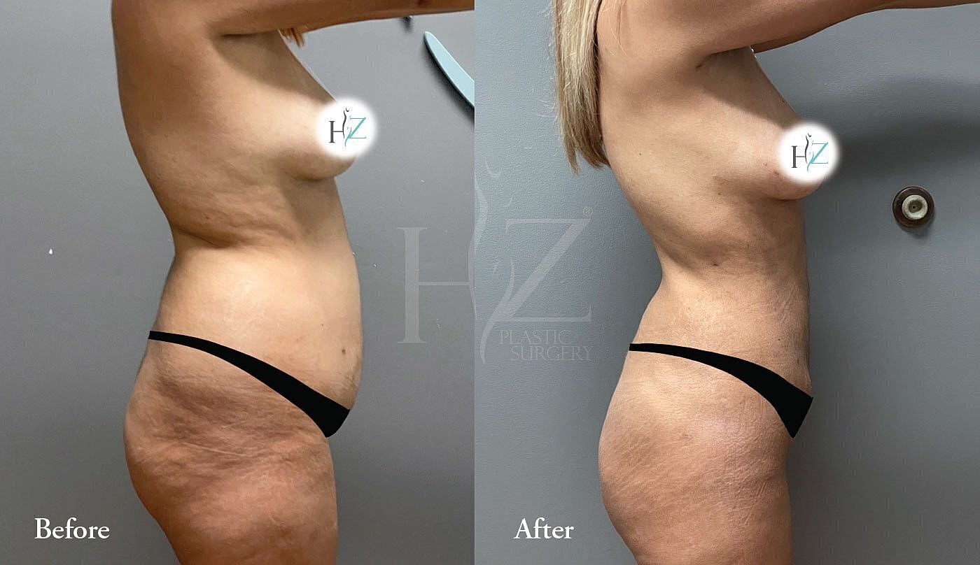 brazilian butt lift patient before and after 4
