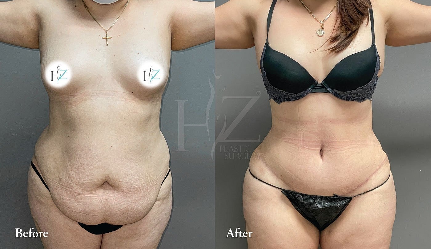 Before and after plastic surgery transformation.