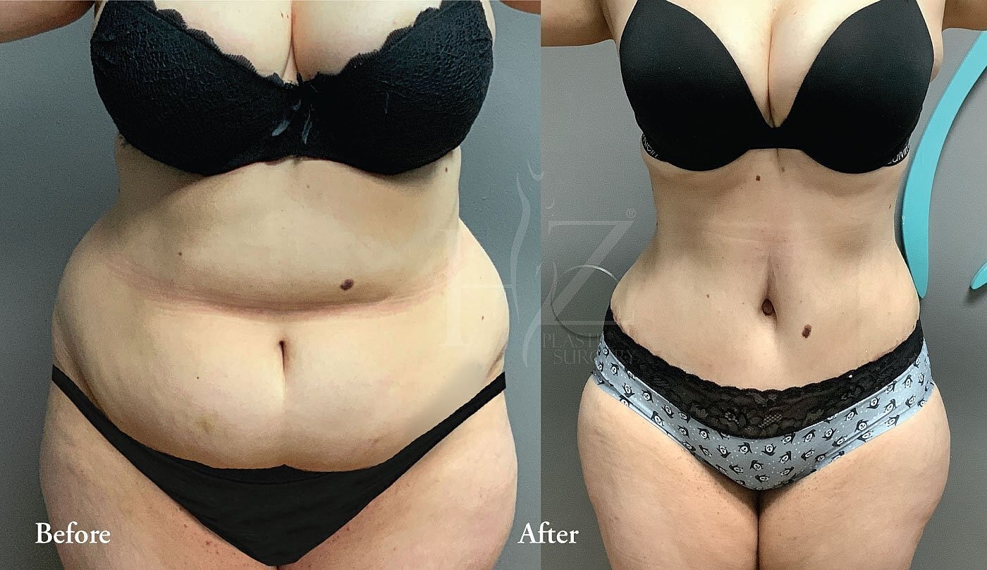 Body transformation before and after surgery.