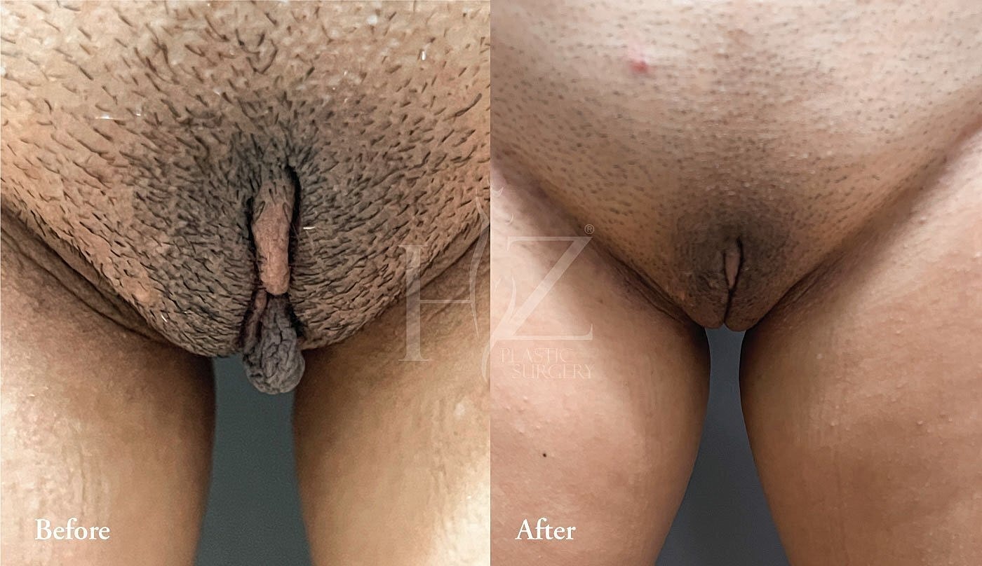 labiaplasty patient before and after 1