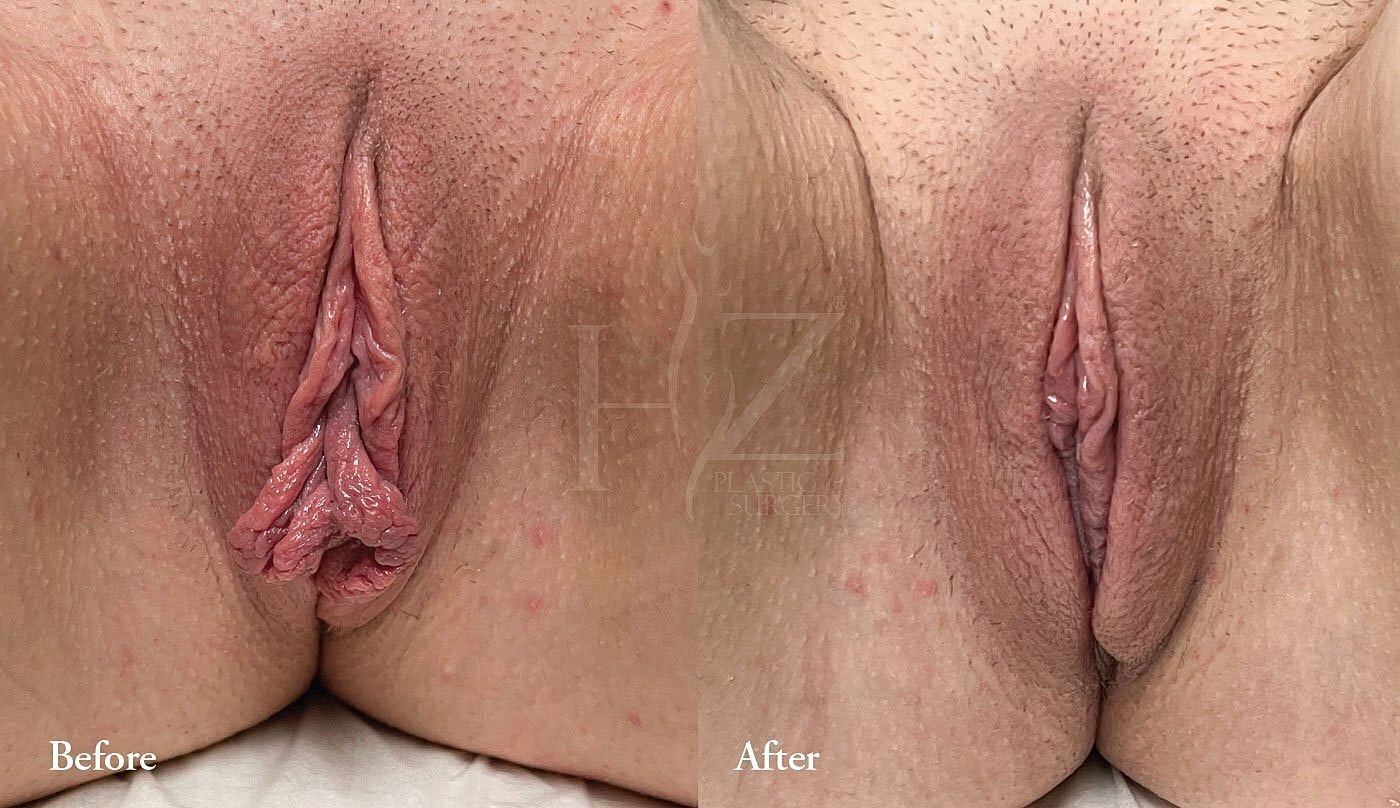 labiaplasty patient before and after 3