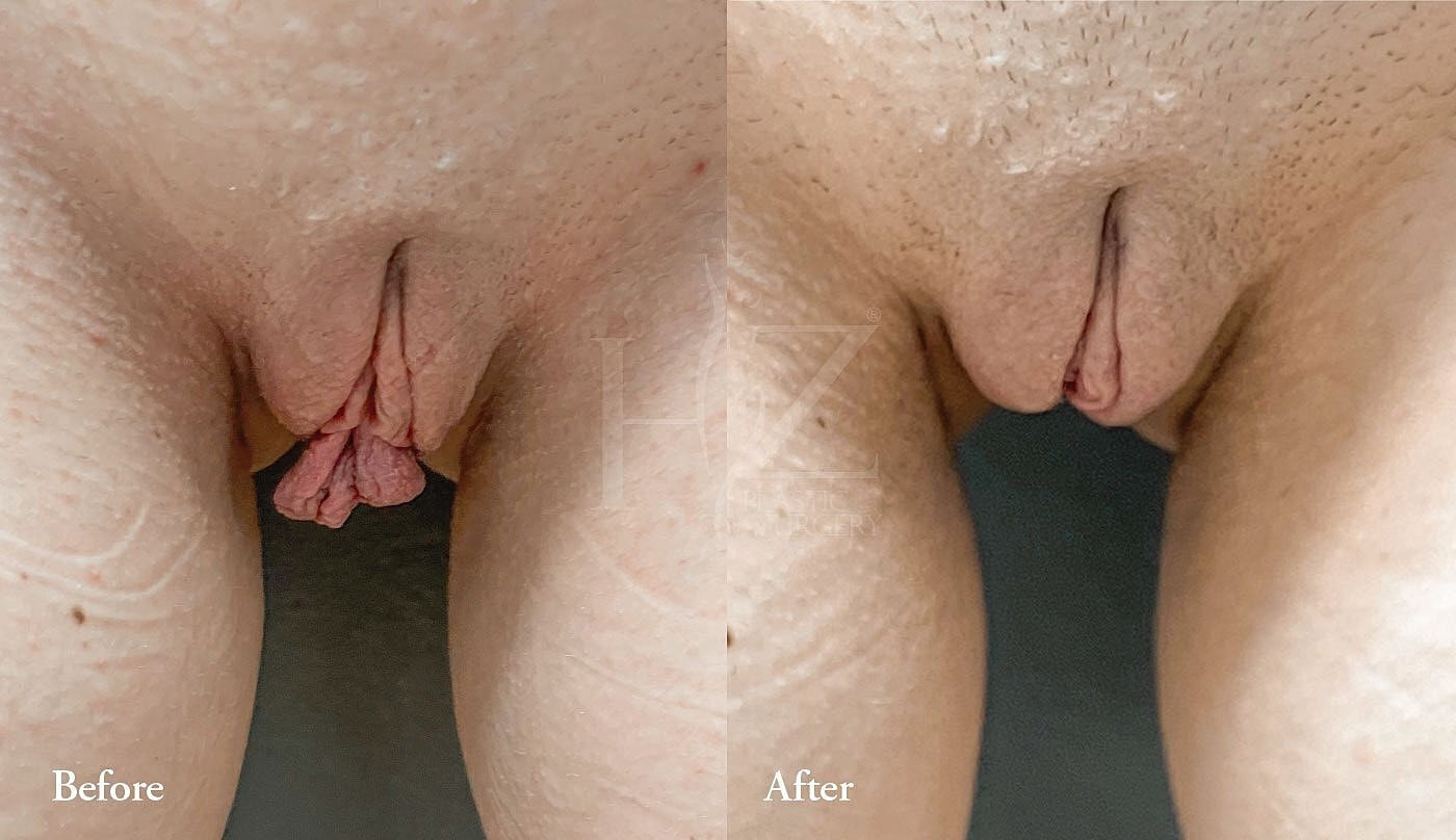 labiaplasty patient before and after 4