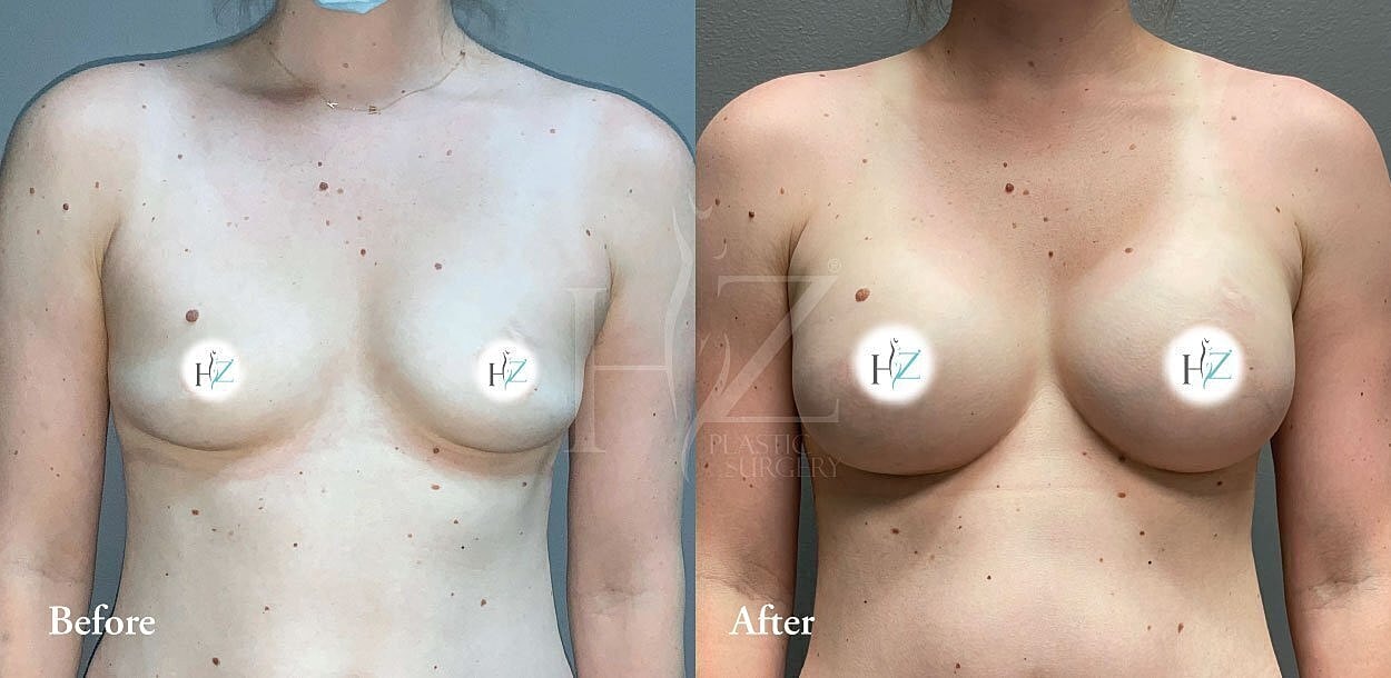 breast augmentation before and after 2