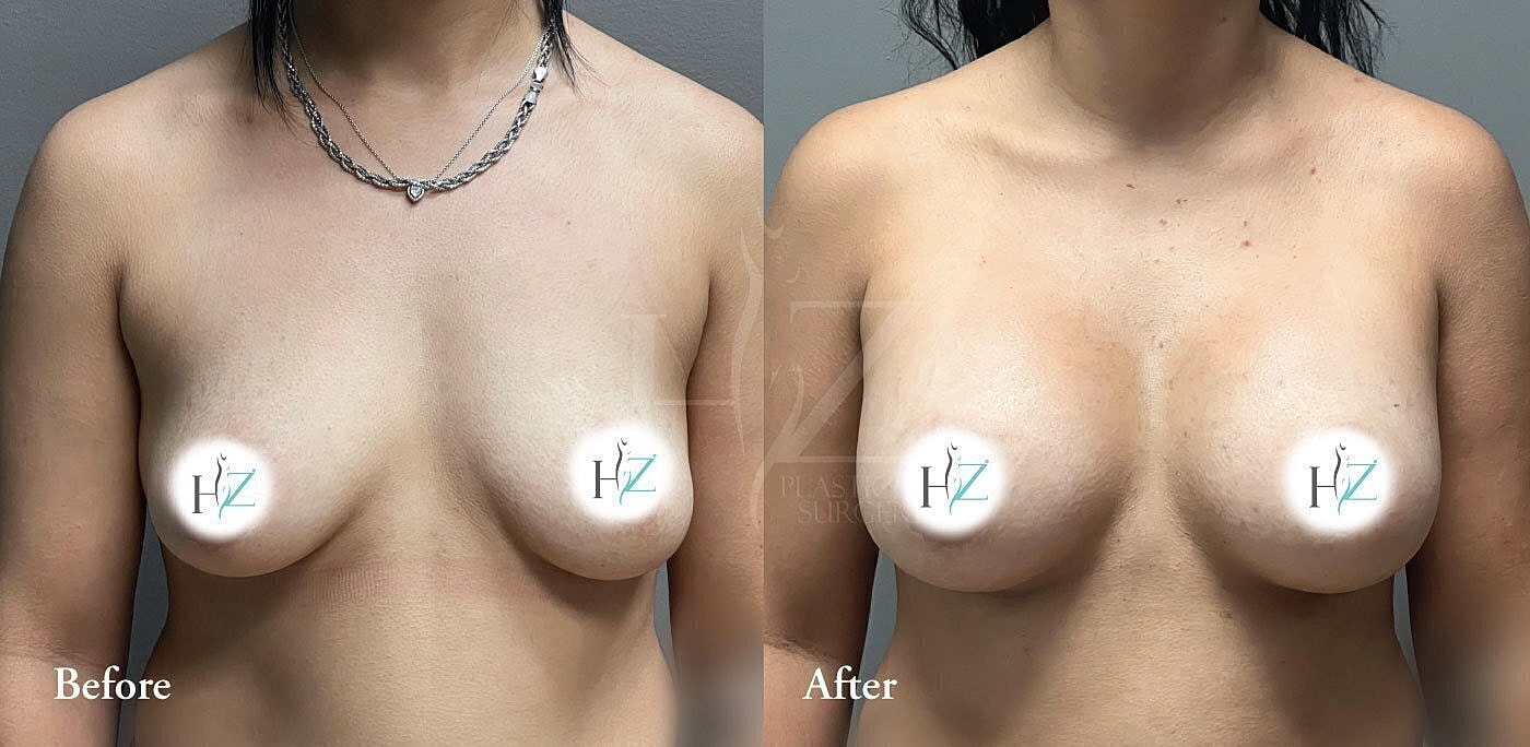 breast augmentation before and after 3
