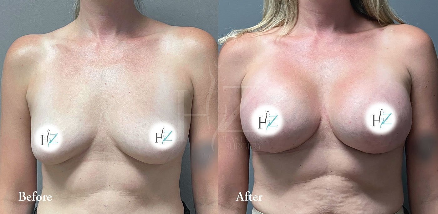 breast augmentation before and after 4