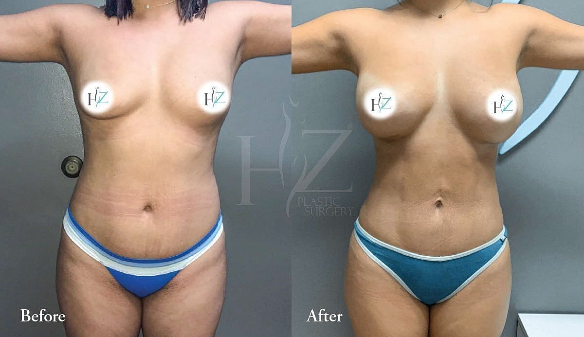 liposuction patient before and after 1