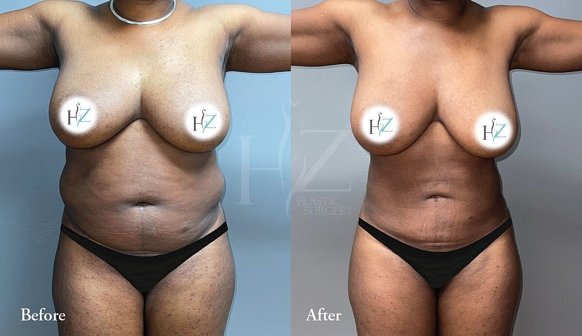liposuction patient before and after 3