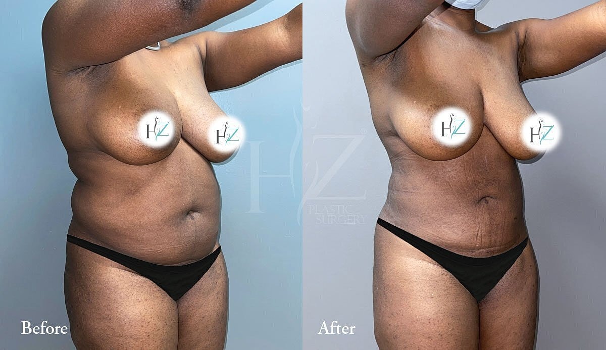 liposuction patient before and after 4