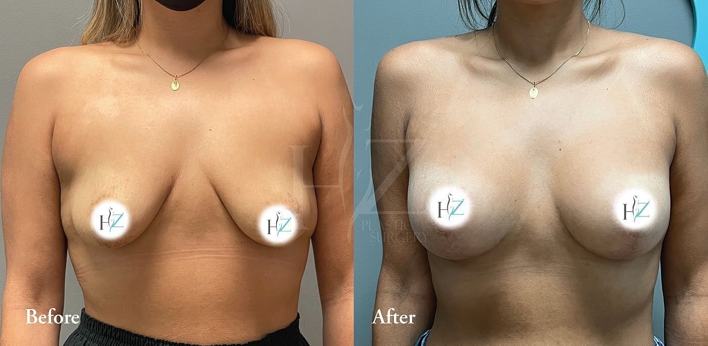 breast augmentation with lift patient before and after 1