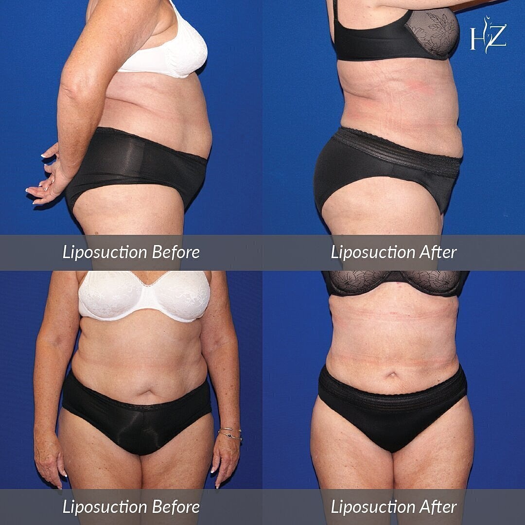 liposuction before and after, liposuction orlando, plastic surgeon orlando, plastic surgery before and afters