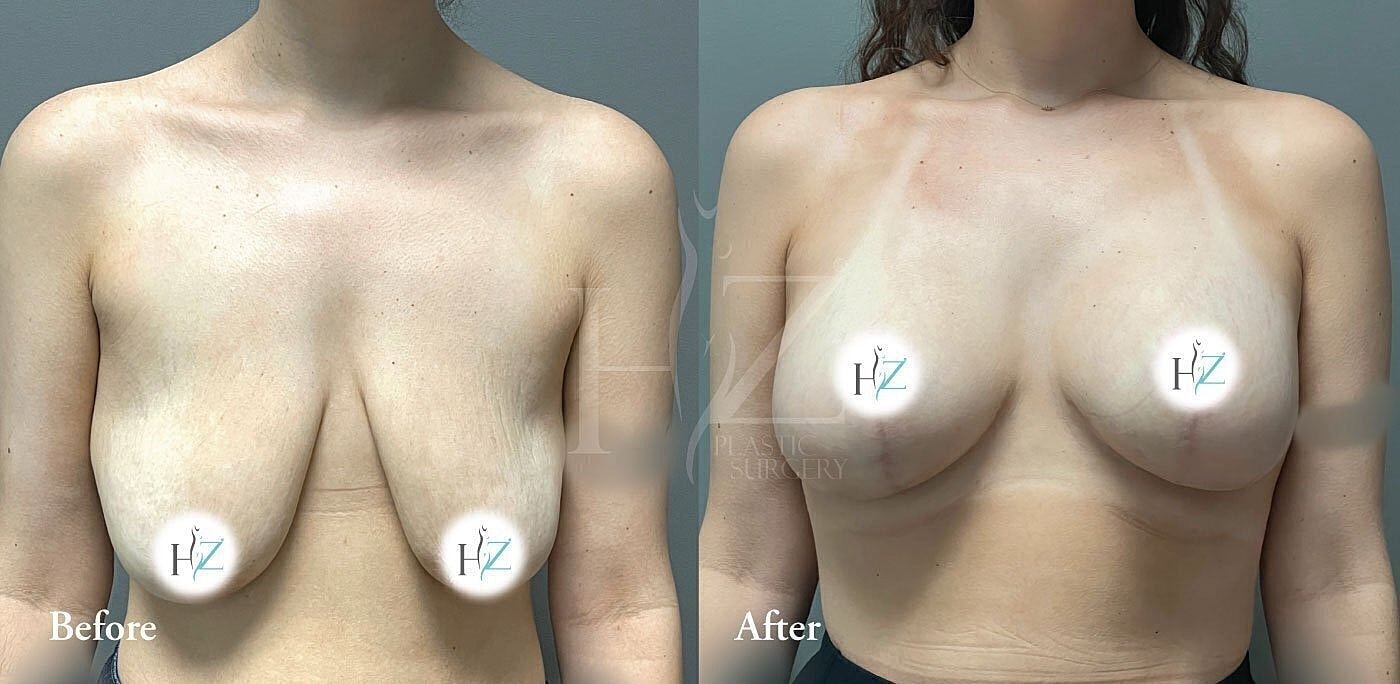 breast augmentation with lift patient before and after 2