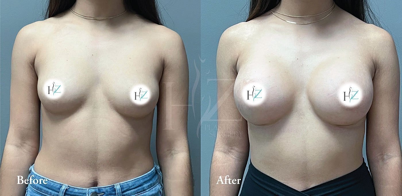 breast augmentation before and after 2