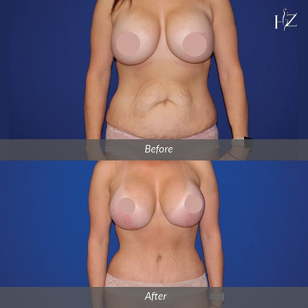 mommy makeover before and after, mommy makeover orlando, plastic surgeon orlando, plastic surgery before and afters