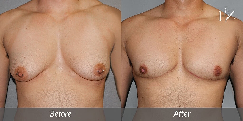 6 Top Surgery FAQ&apos;s