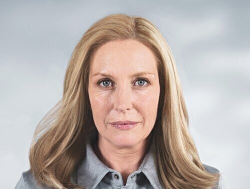 sculptra patient before photo 1