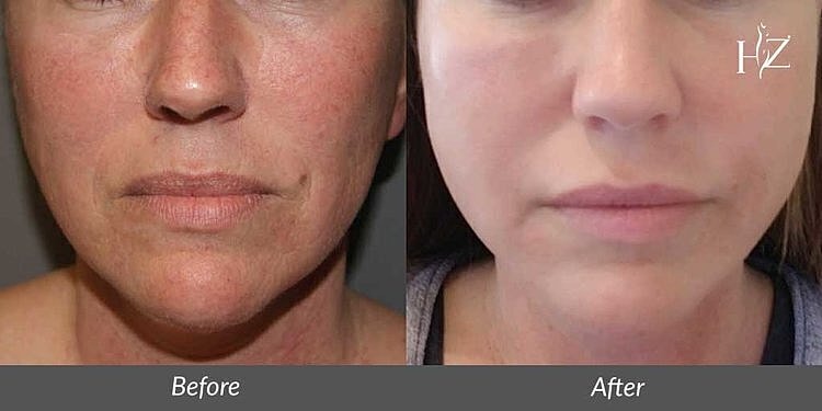 facial fat transfer patient before and after