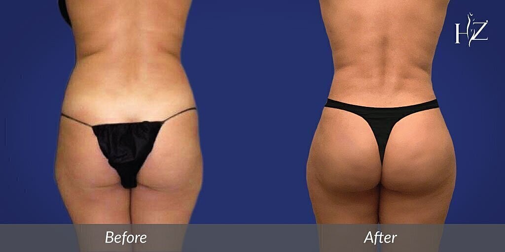 brazilian butt lift patient before and after