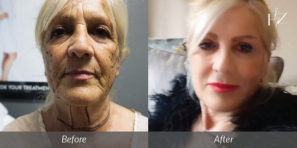blepharoplasty patient before and after 2