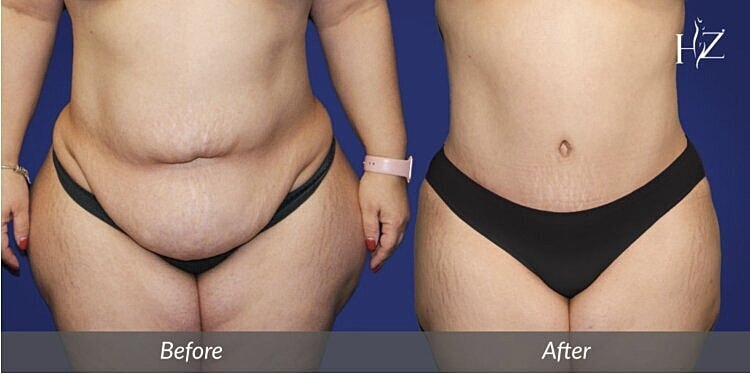 Am I A Good Candidate For A Tummy Tuck?