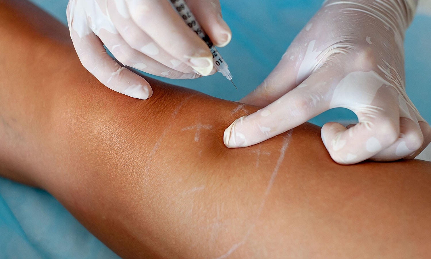 Am I A Good Candidate For Sclerotherapy?