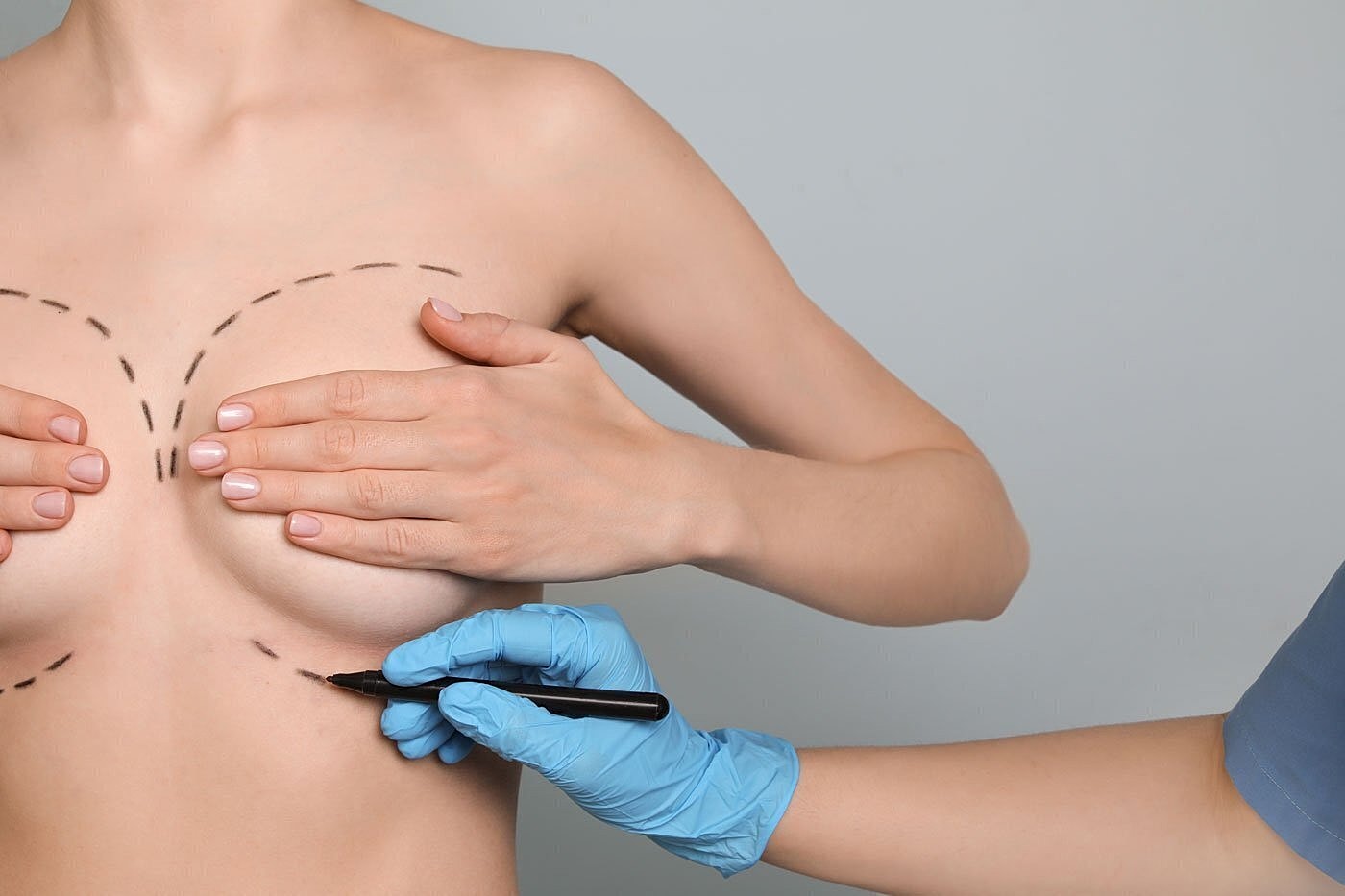 Can You Get A Breast Lift Without Implants?