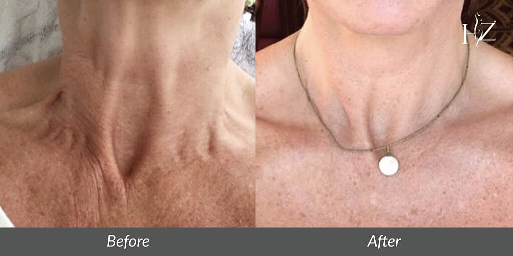 Neck Lift Recovery Day By Day
