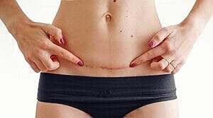 Scar Revision Surgery 101: What It Is, How It Works, & Why You Should Get It