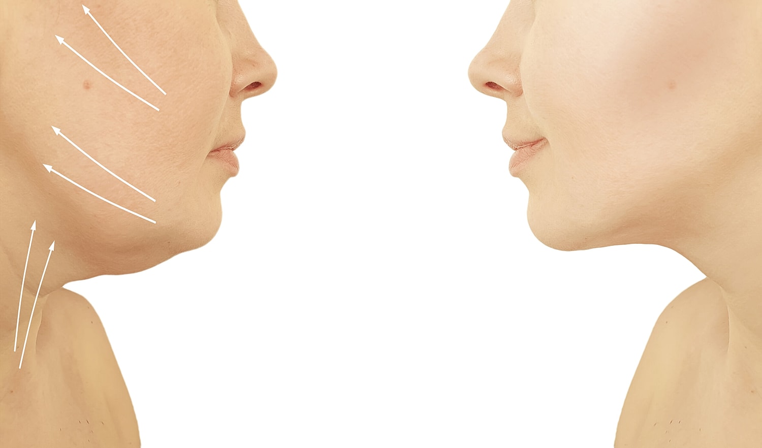 What You Should Know About Facelifts