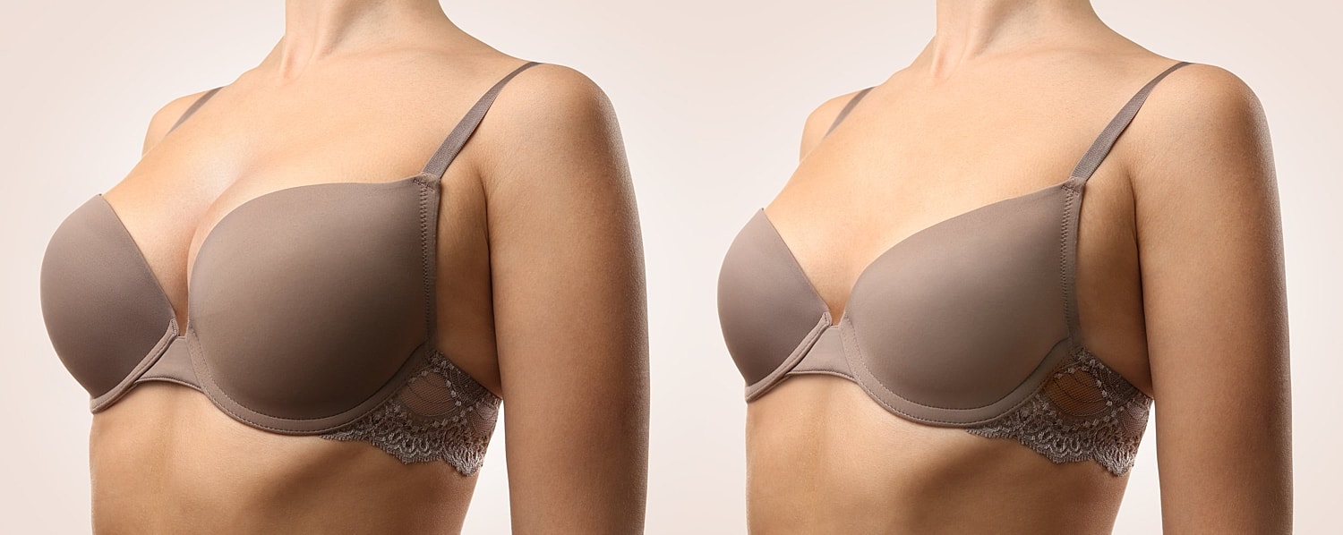 Breast Augmentation Recovery Week By Week
