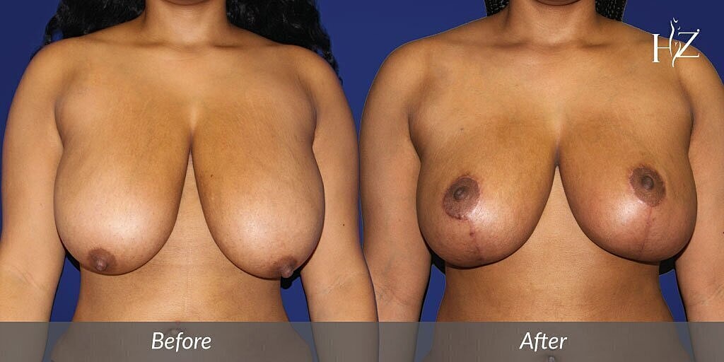 Breast surgery before and after comparison image.