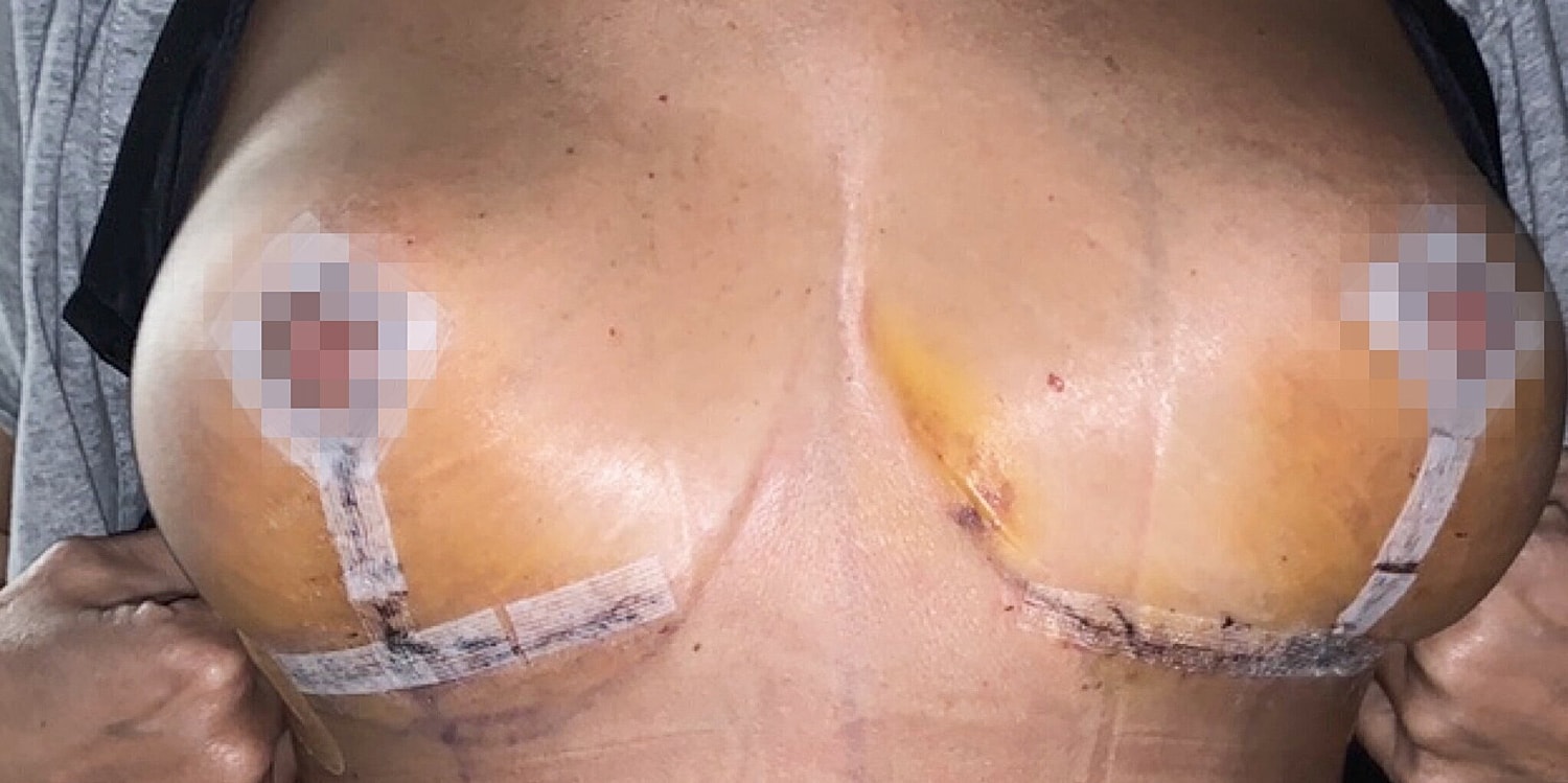 Post-operative chest with dressings and bruising.