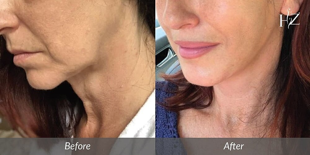 Before and after skincare treatment results.