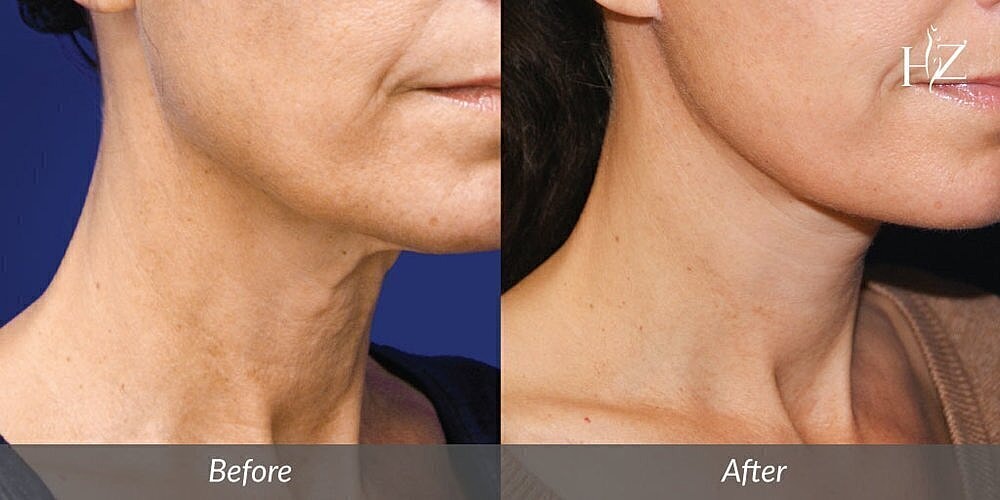 Before and after skin rejuvenation treatment comparison.