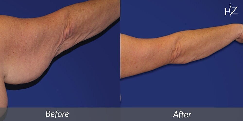 Arm transformation before and after treatment.