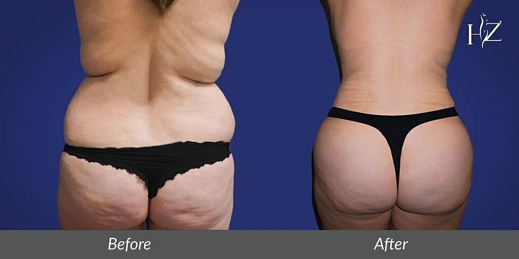 Body transformation before and after comparison.