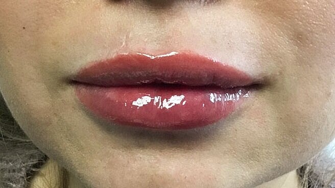 juvederm AFTER 2