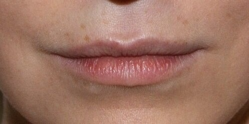 juvederm BEFORE 1