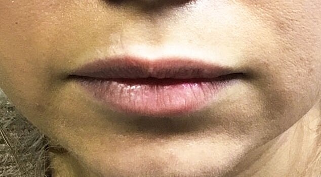 juvederm BEFORE 2
