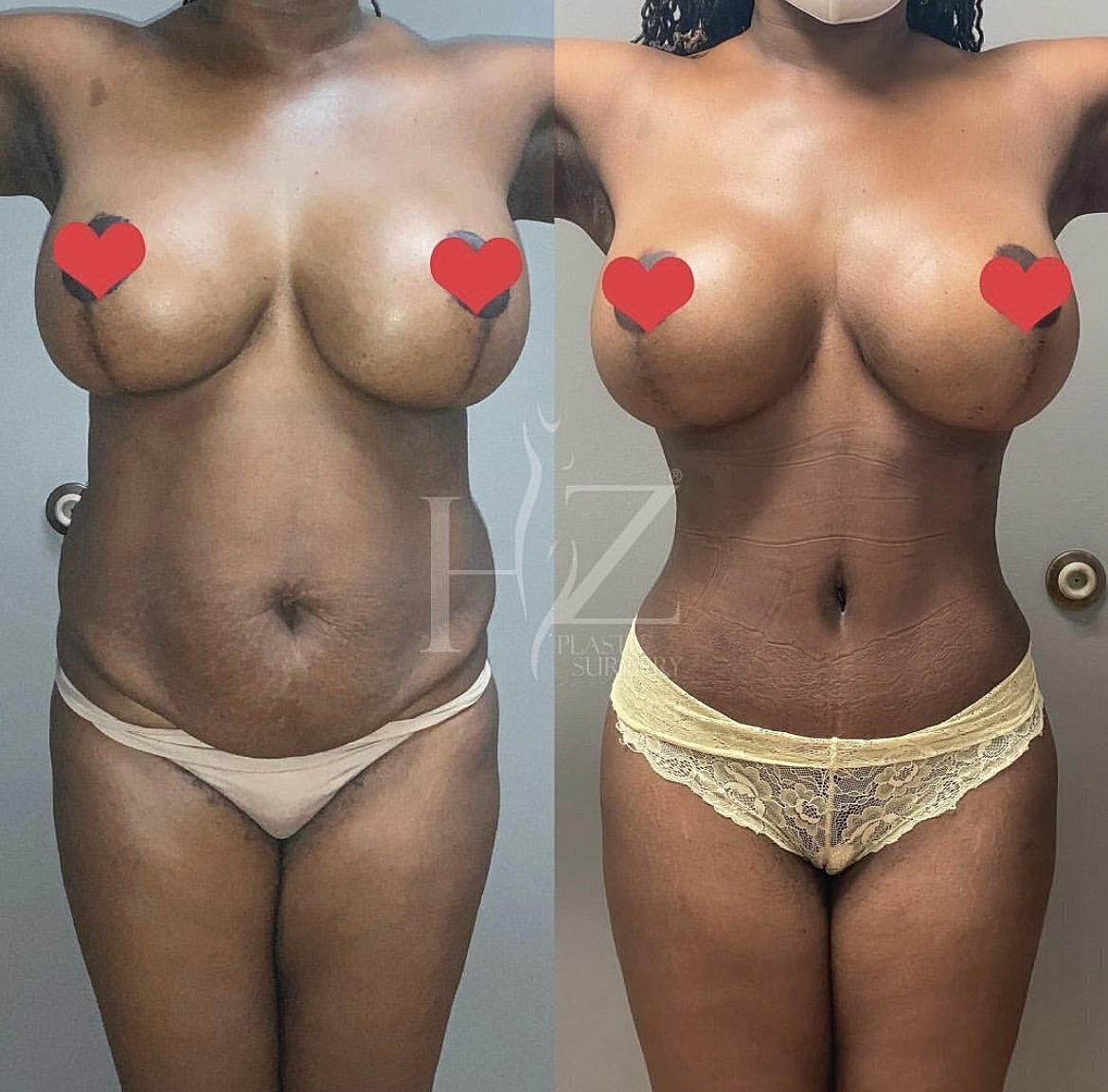 Before and after cosmetic surgery transformation.