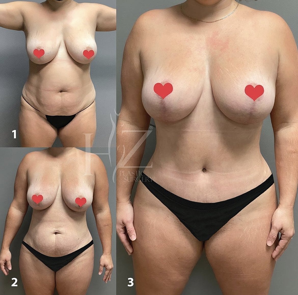 Post-surgery body transformation photos displayed.