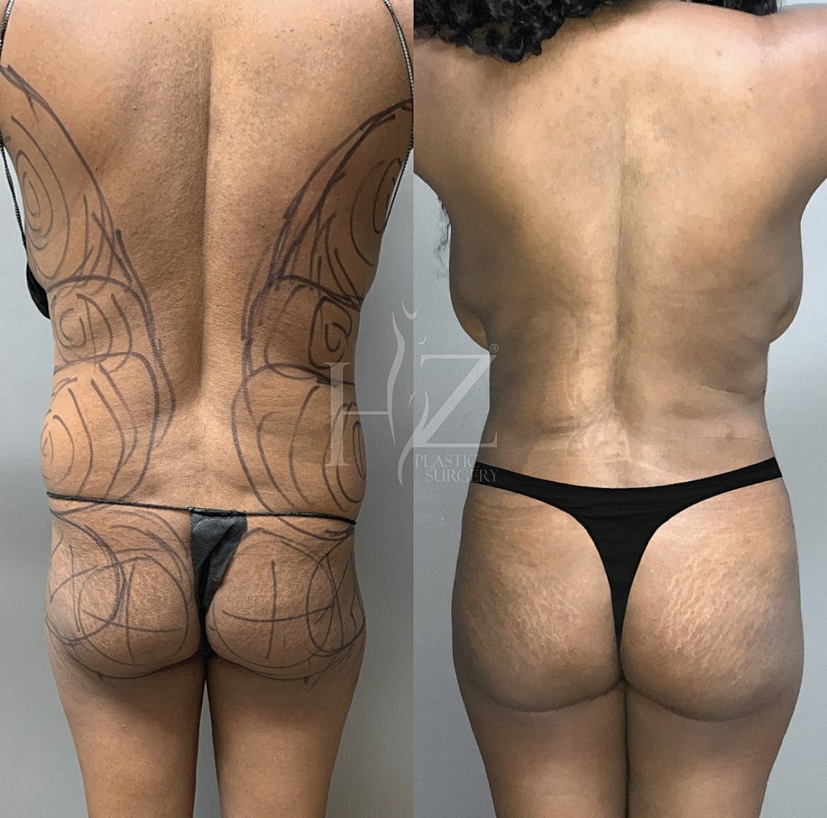 Before and after body contouring procedure comparison.