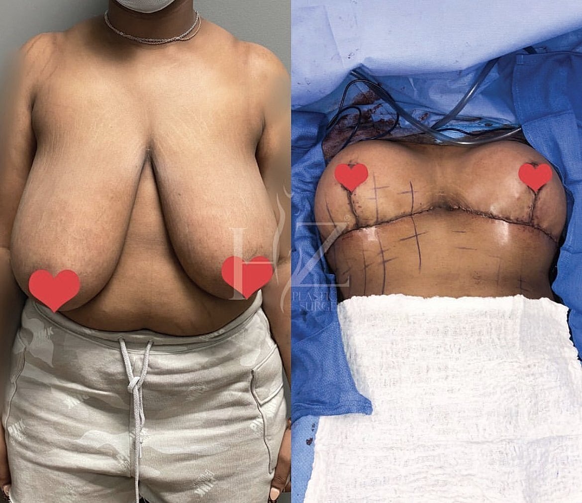 Before and after breast surgery images.