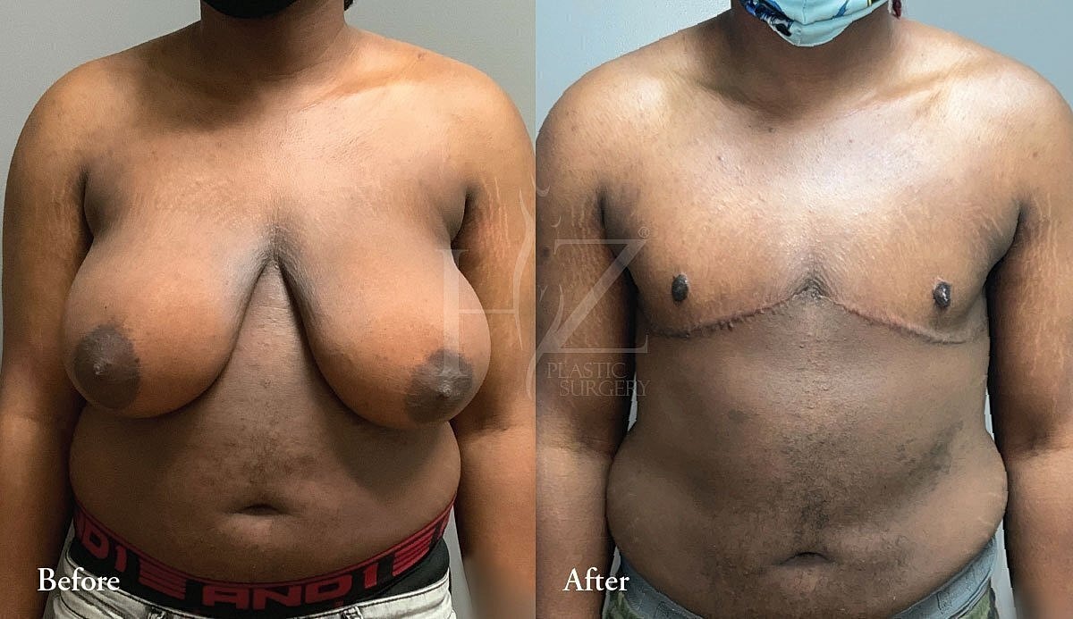 Before and after chest transformation photos.