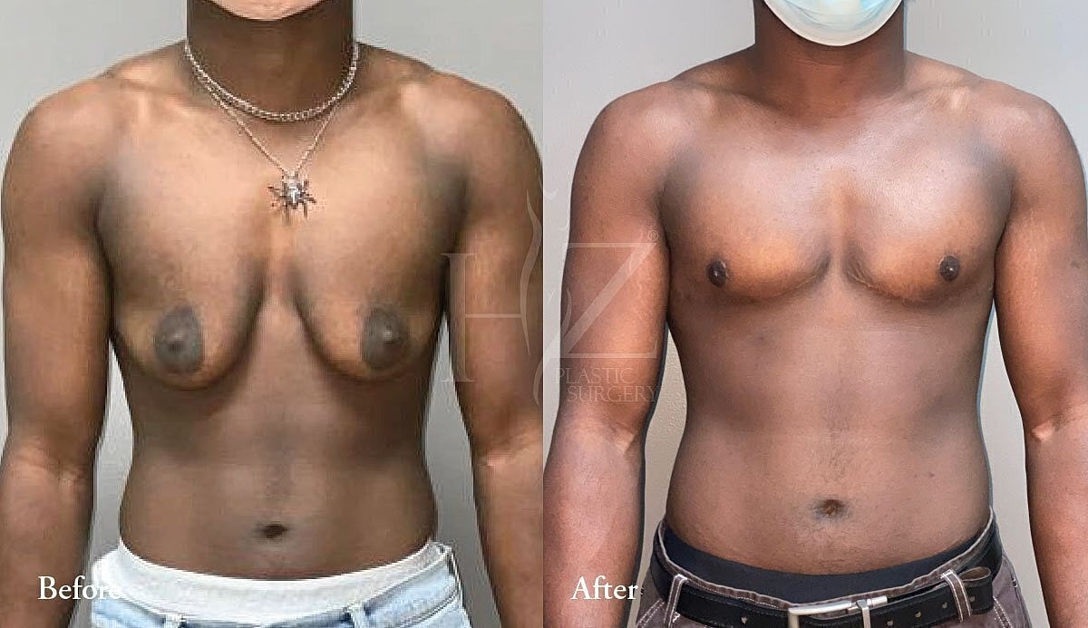 Before and after chest transformation procedure.