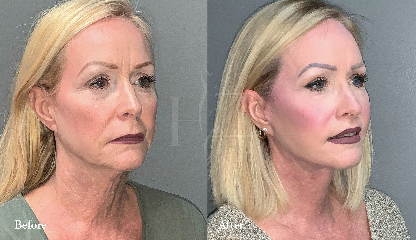 Before and after cosmetic treatment comparison image
