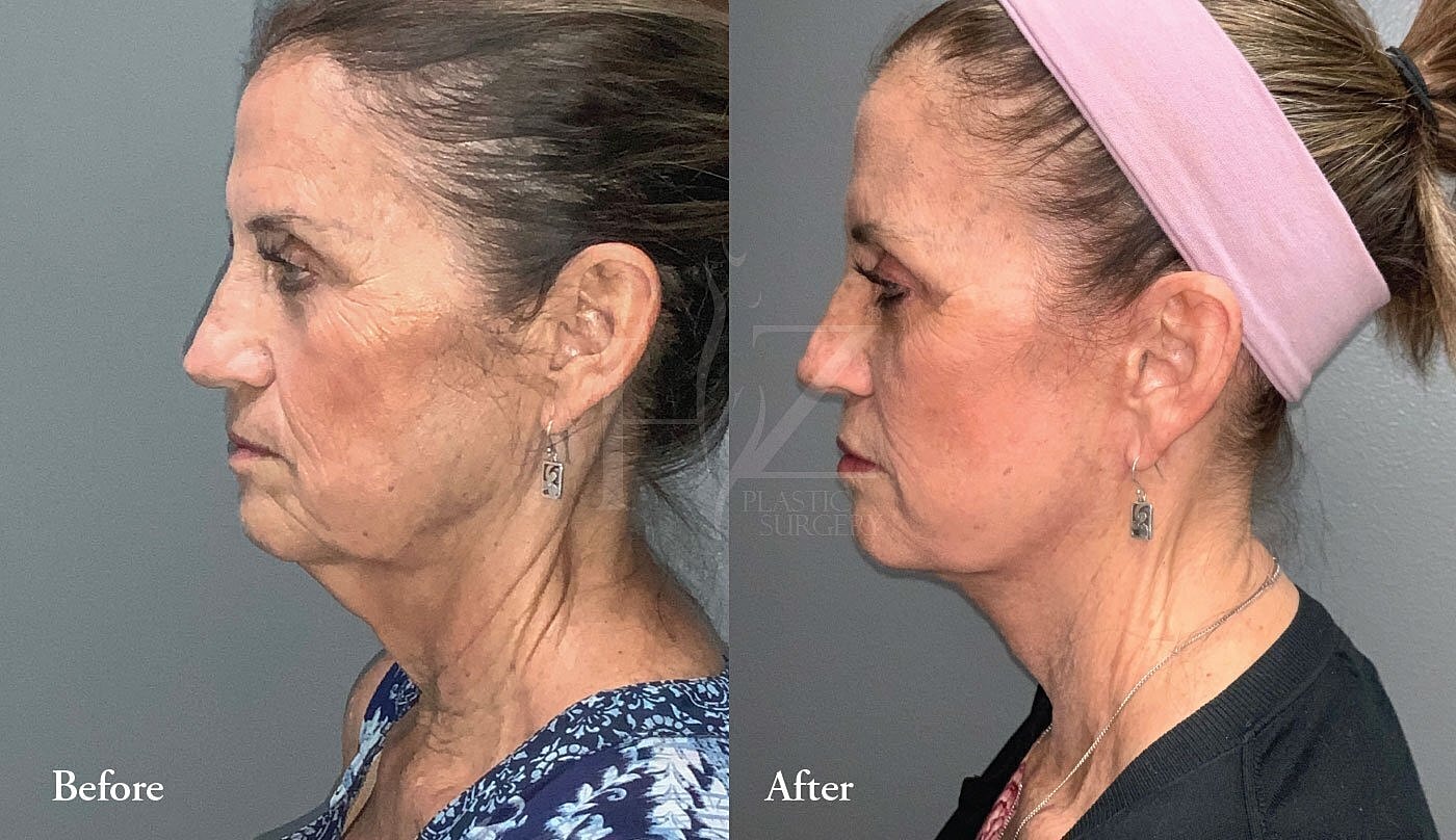 Before and after side profile of middle-aged woman.