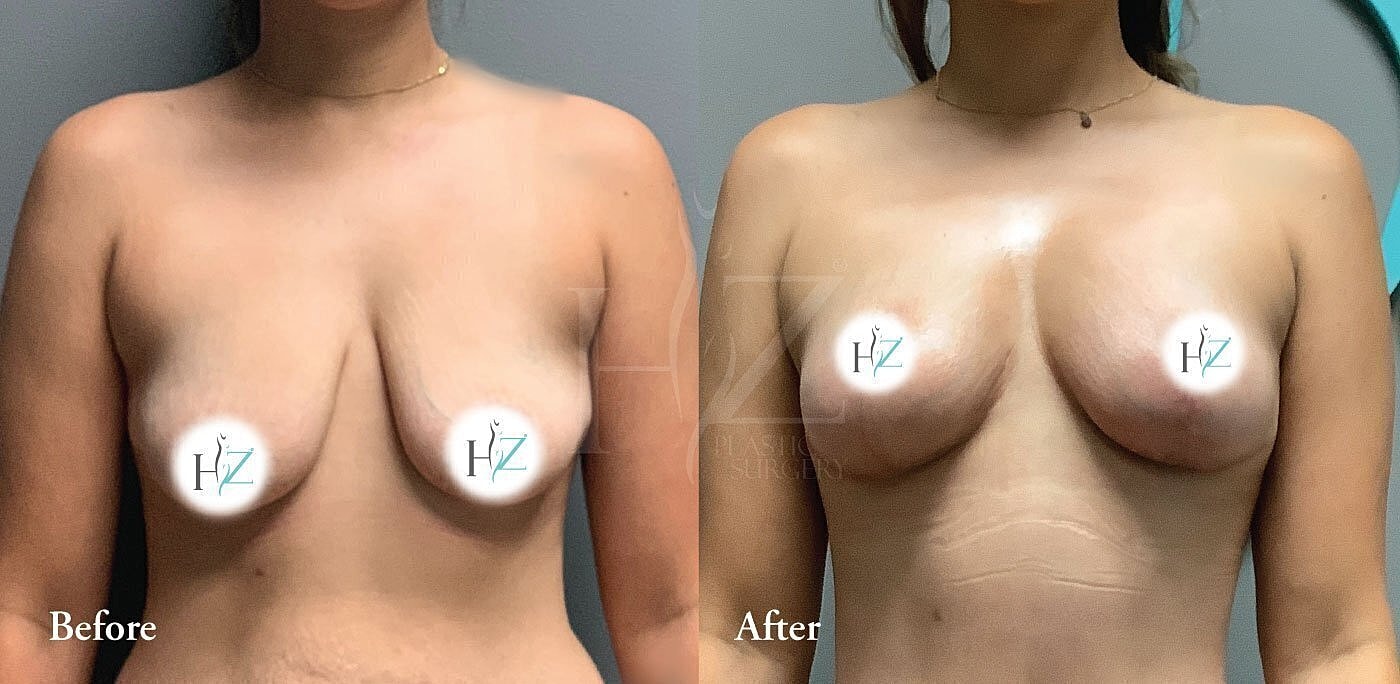 Before and after breast enhancement comparison image.