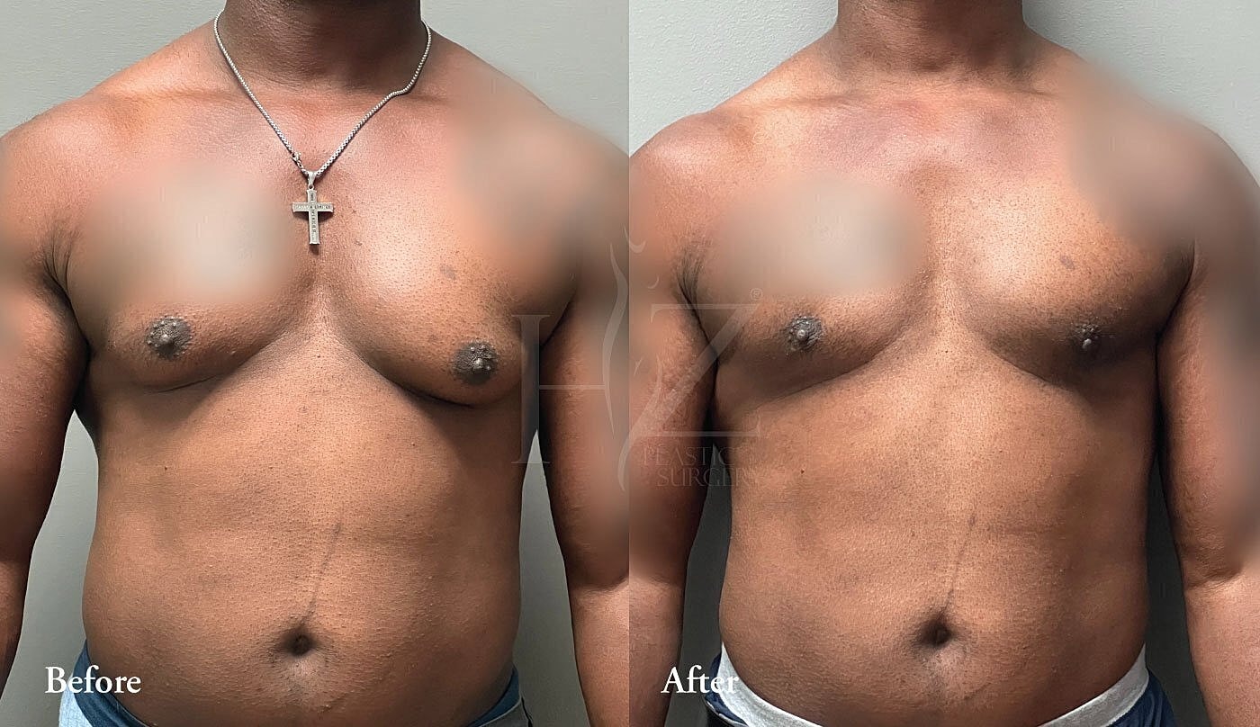 Before and after body transformation comparison.