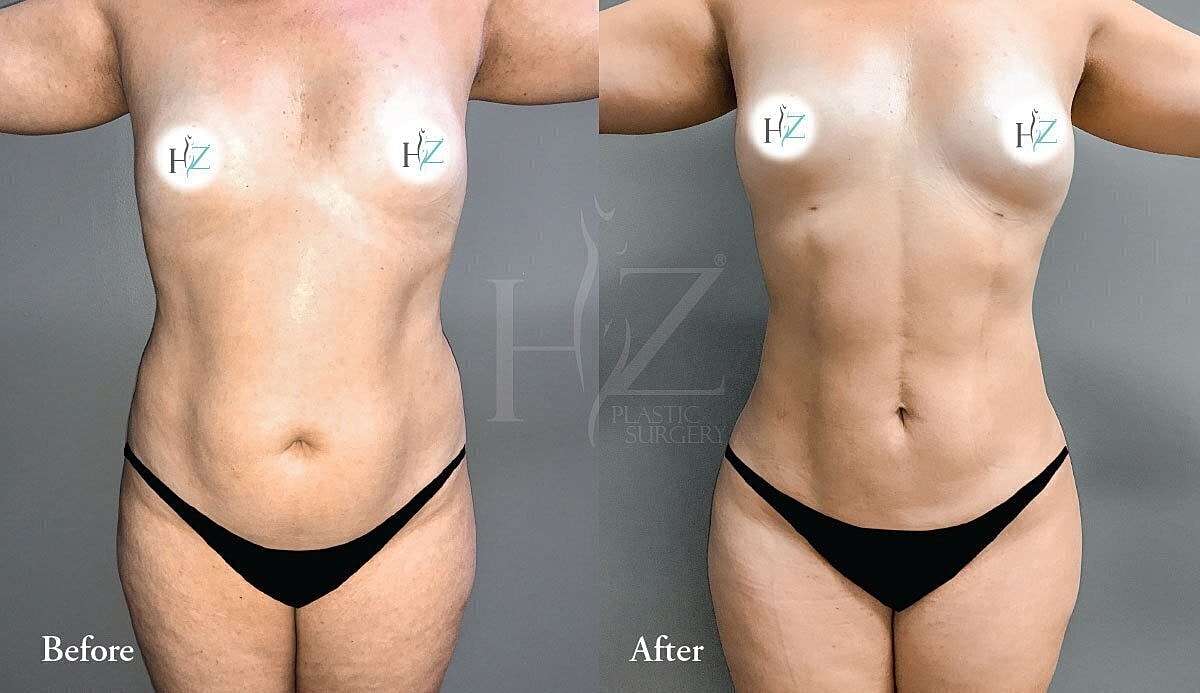 Breast enhancement before and after comparison.